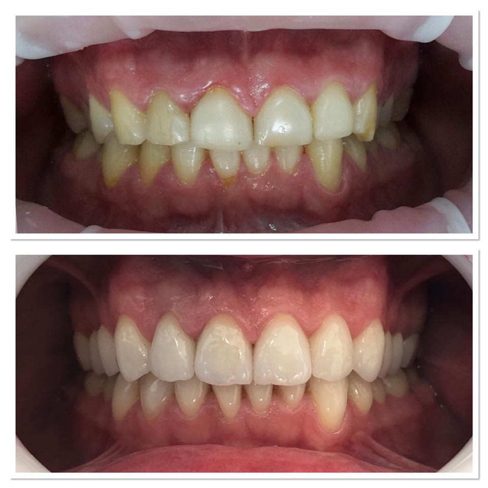 Fațete Dentare ( Veneers)