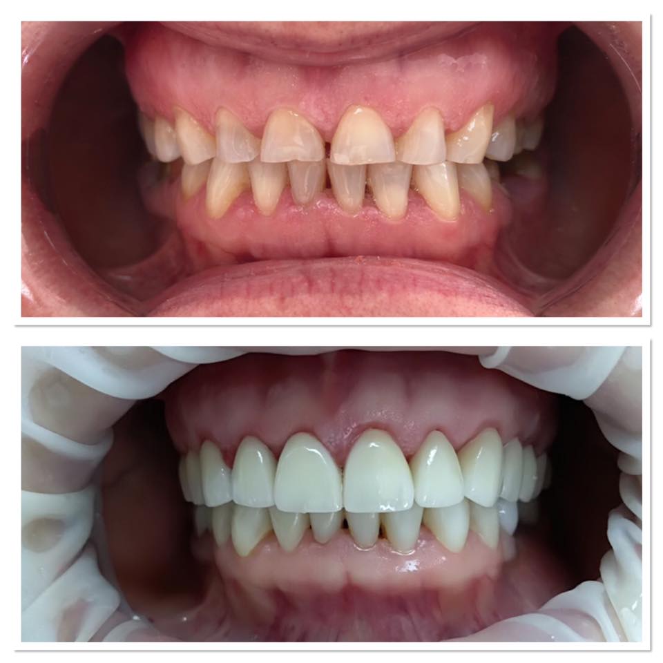 Fațete Dentare ( Veneers)