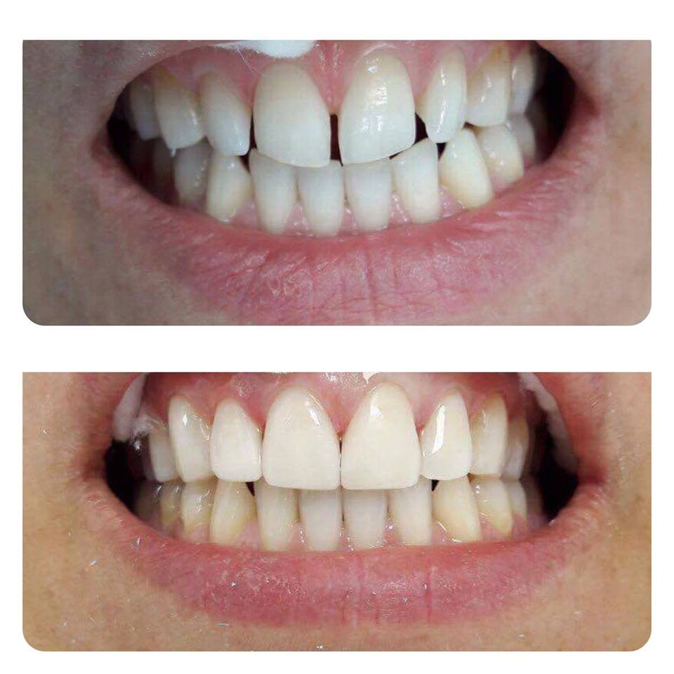 Restaurări estetice