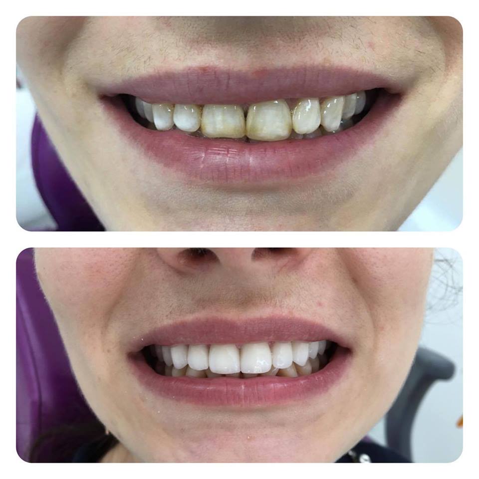 Fațete Dentare ( Veneers)