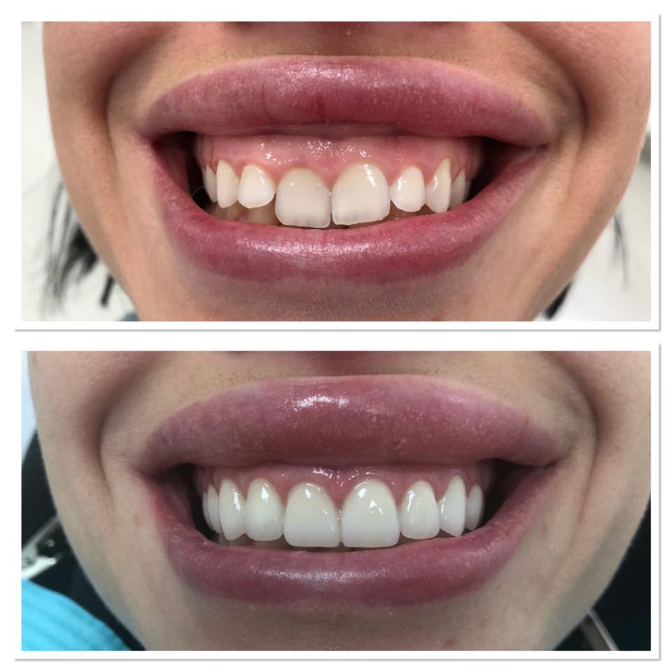 Fațete Dentare ( Veneers)