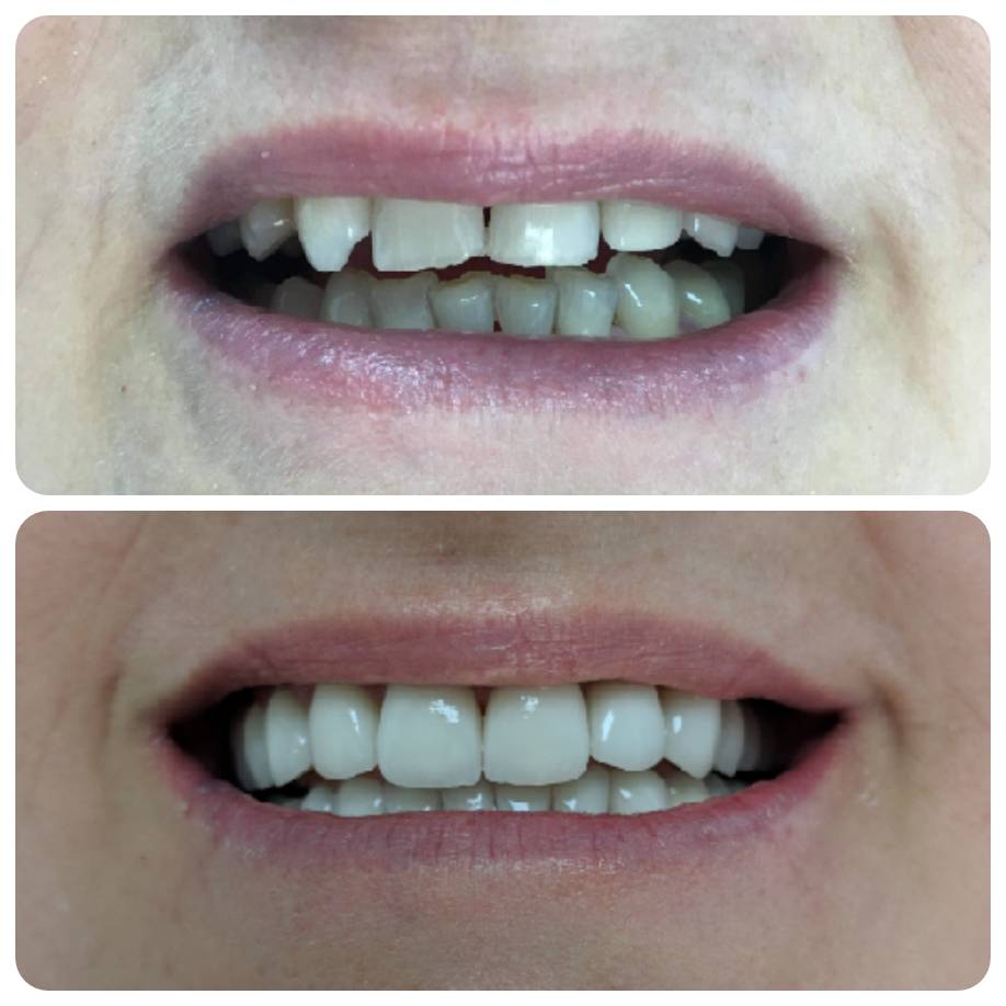 Fațete Dentare ( Veneers)