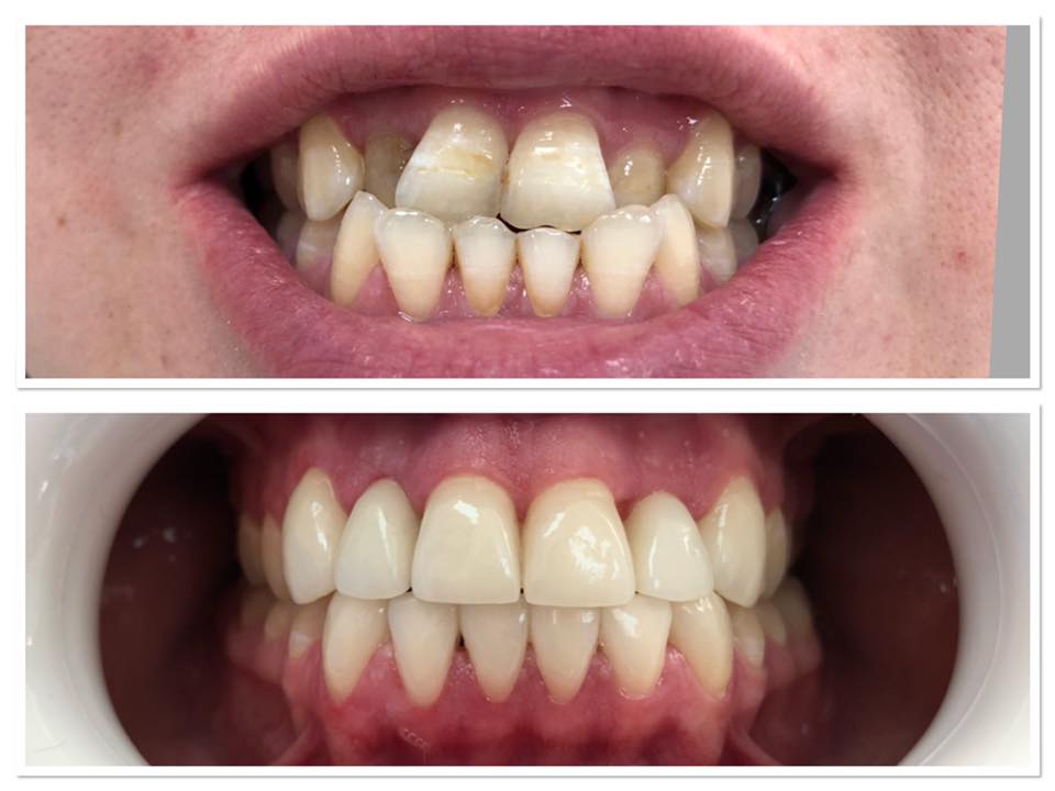 Fațete Dentare ( Veneers)