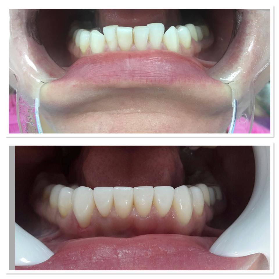Fațete Dentare ( Veneers)