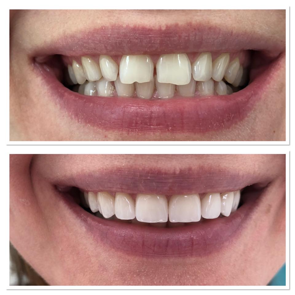 Fațete Dentare ( Veneers)