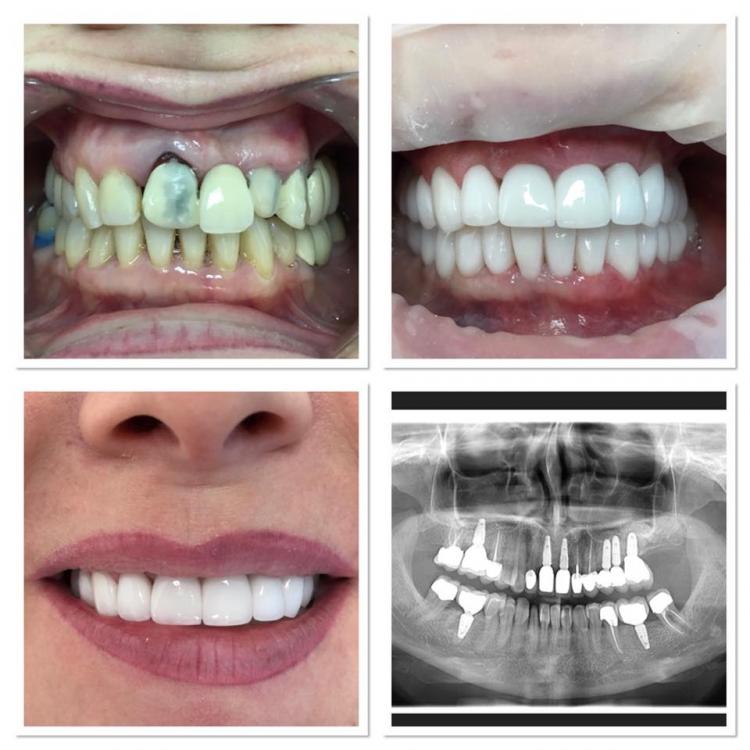 Fațete dentare / veneers — 1