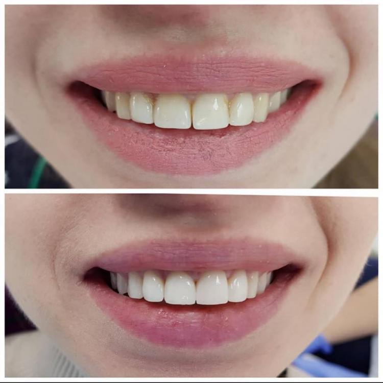 Ricostruzioni estetiche dentali — 1
