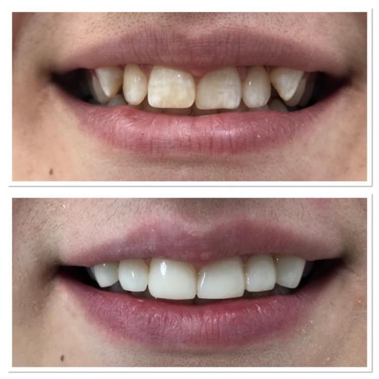 Ricostruzioni estetiche dentali — 3