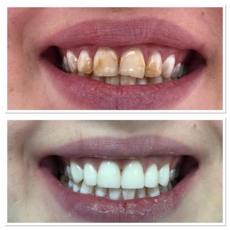 Ricostruzioni estetiche dentali — 4
