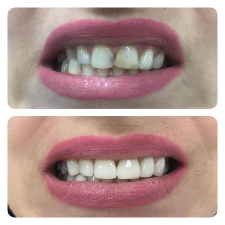 Ricostruzioni estetiche dentali — 5