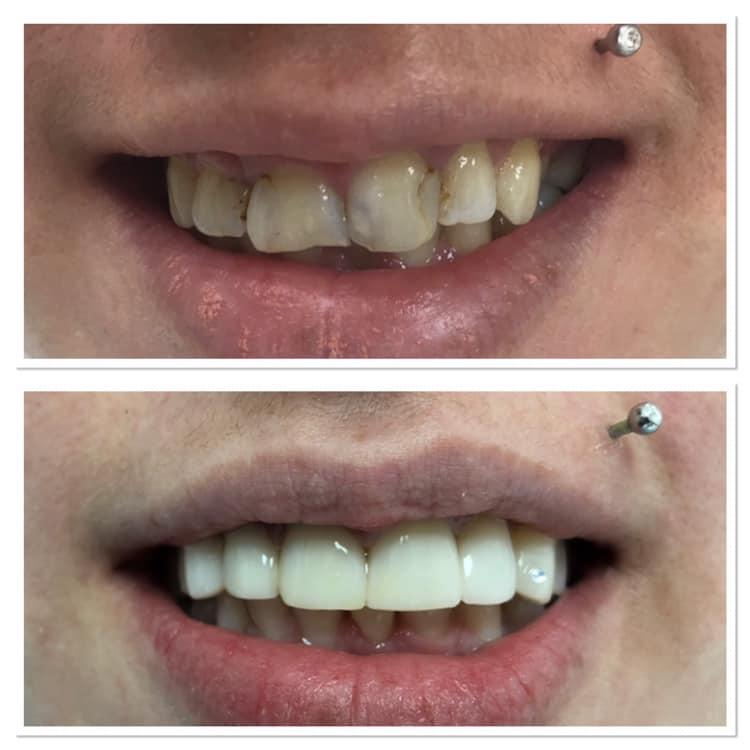 Fațete dentare / veneers — 4