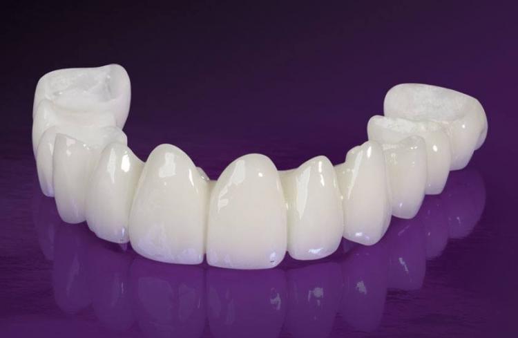 Coroane dentare din zirconiu — 1