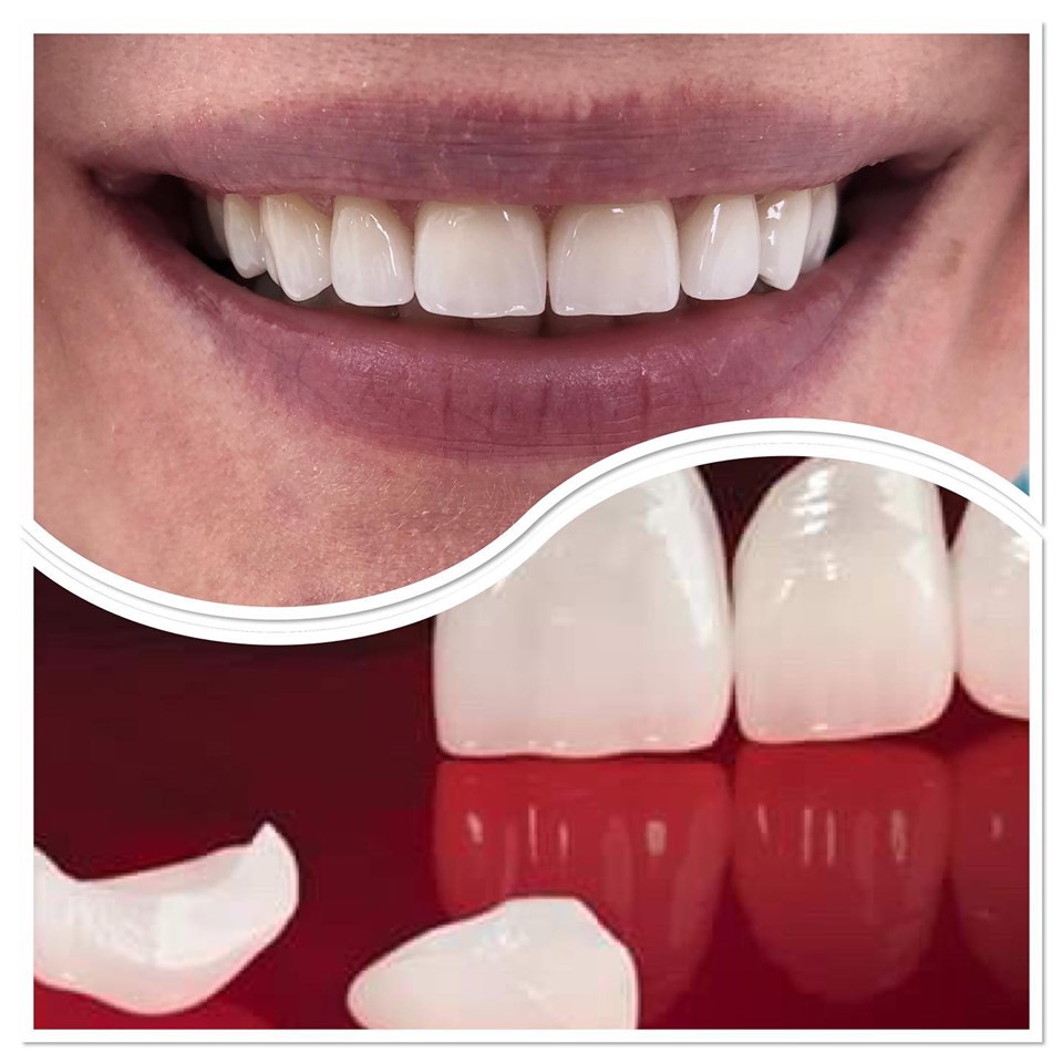 Dental veneers / smile design